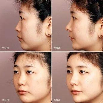 明星都怎么隆鼻,打造完美鼻型的秘密武器